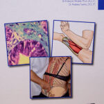 Creeping Fascial